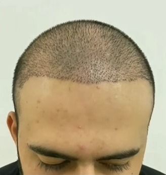 Saç Əkimi