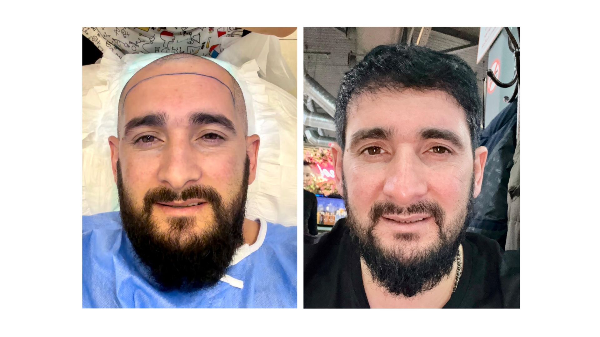 Saç Əkimi